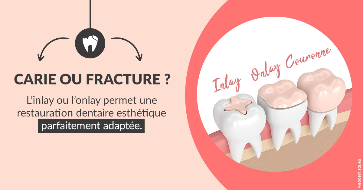 https://dr-knafou-abensur-anita.chirurgiens-dentistes.fr/T2 2023 - Carie ou fracture 2