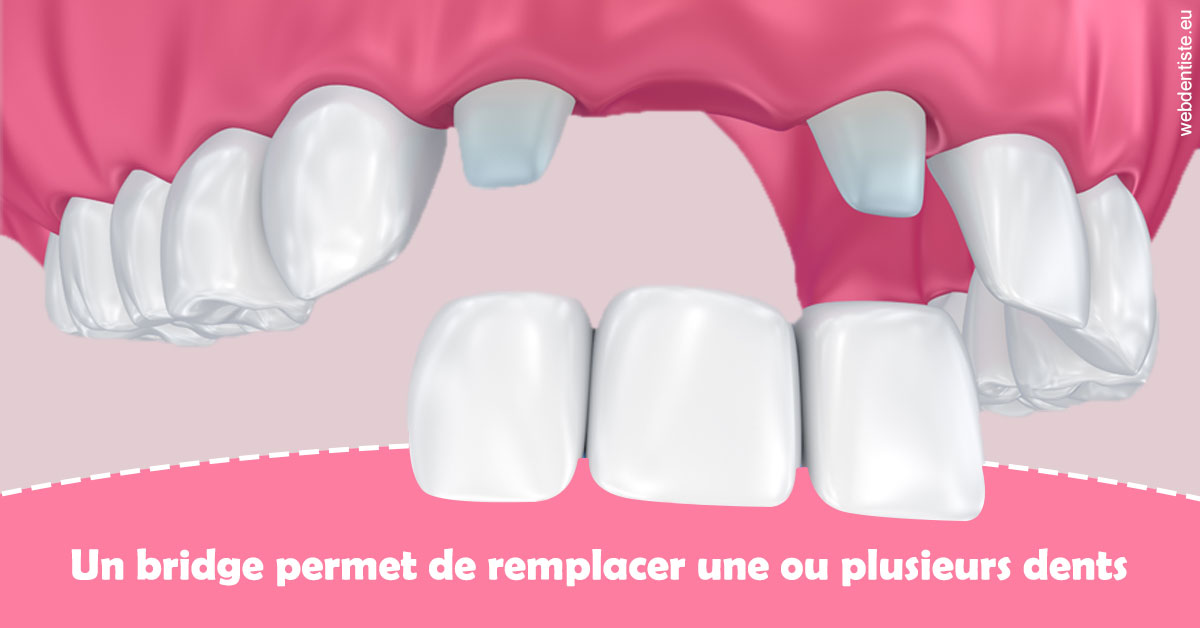 https://dr-knafou-abensur-anita.chirurgiens-dentistes.fr/Bridge remplacer dents 2