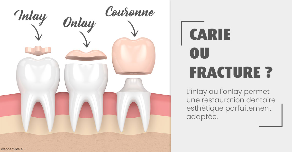 https://dr-knafou-abensur-anita.chirurgiens-dentistes.fr/T2 2023 - Carie ou fracture 1
