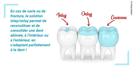 https://dr-knafou-abensur-anita.chirurgiens-dentistes.fr/L'INLAY ou l'ONLAY