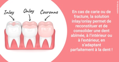 https://dr-knafou-abensur-anita.chirurgiens-dentistes.fr/L'INLAY ou l'ONLAY 2