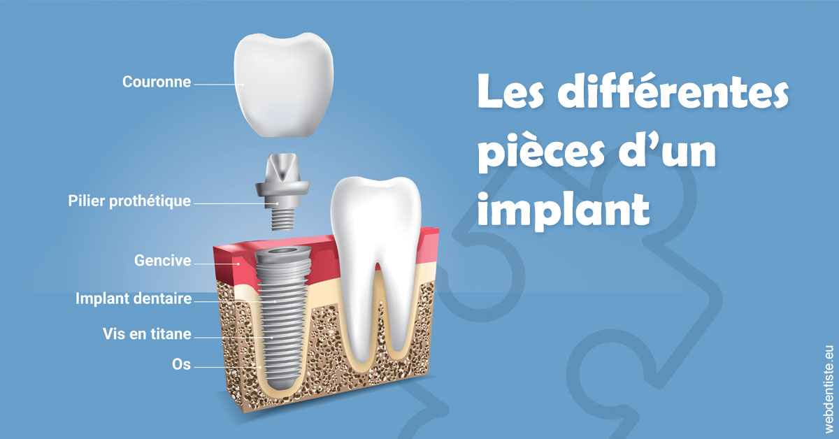 https://dr-knafou-abensur-anita.chirurgiens-dentistes.fr/Les différentes pièces d’un implant 1